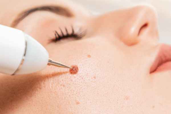 CryoPen: 5 Skin Concerns It May Be Used to Treat 3 What actually happens during a CryoPen treatment Gravesend?